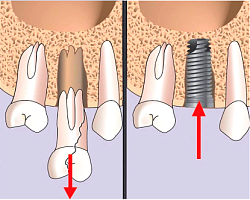 Одномоментная имплантация с удалением зуба